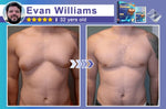 Nano Chest Firming Fatburn Patch