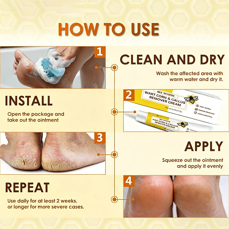 Bee Venom Corn and Callus Removal Cream | Soft Heels for Sandals